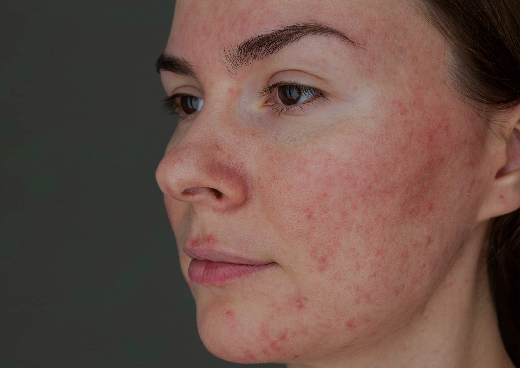 Skin Rosacea treatment Skin Rosacea treatment